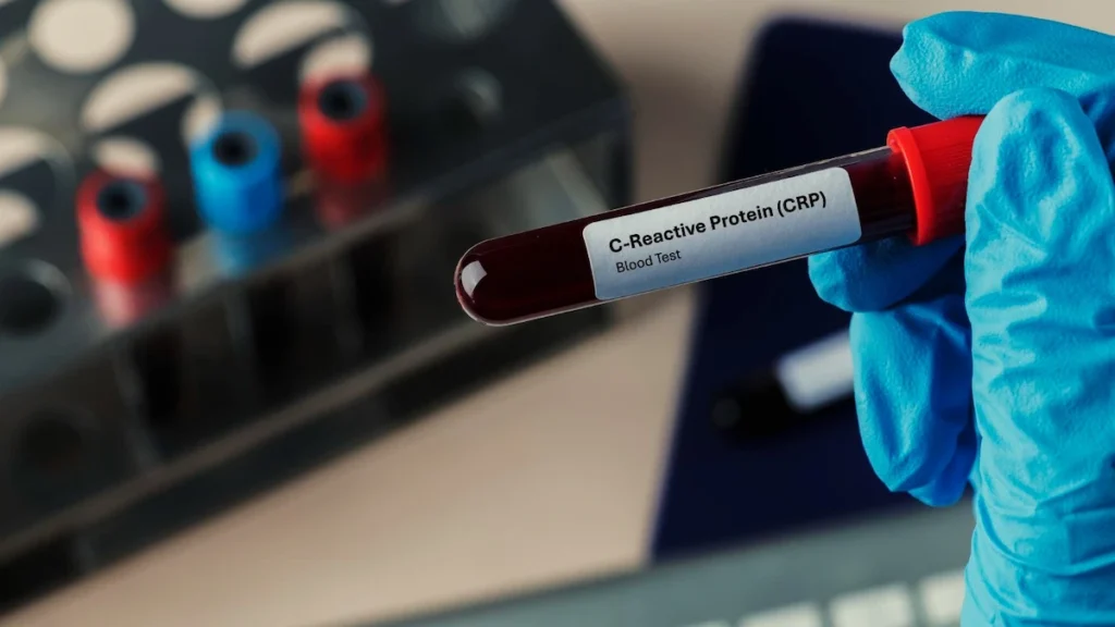 Medical professional holding a blood sample vial for a C-reactive protein test to measure cellular inflammation levels.